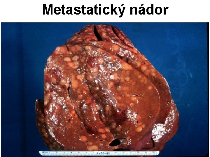 Metastatický nádor 