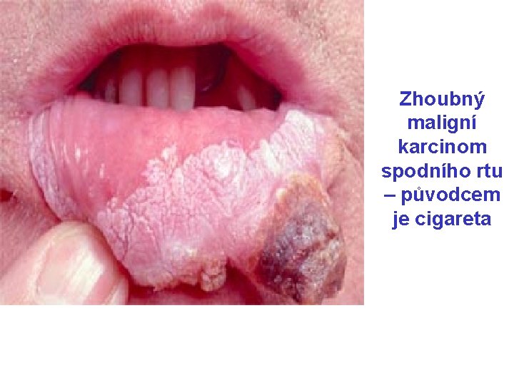 Zhoubný maligní karcinom spodního rtu – původcem je cigareta 