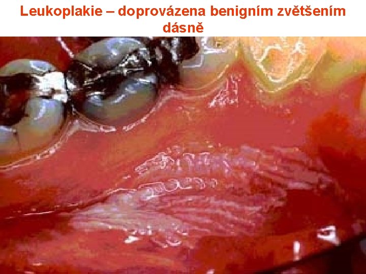 Leukoplakie – doprovázena benigním zvětšením dásně 