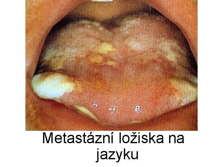 Metastázní ložiska na jazyku 