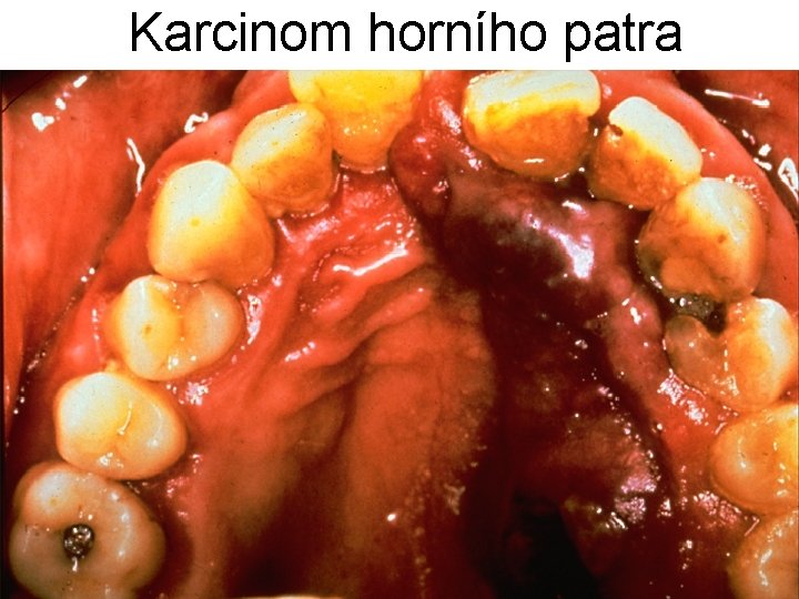 Karcinom horního patra 