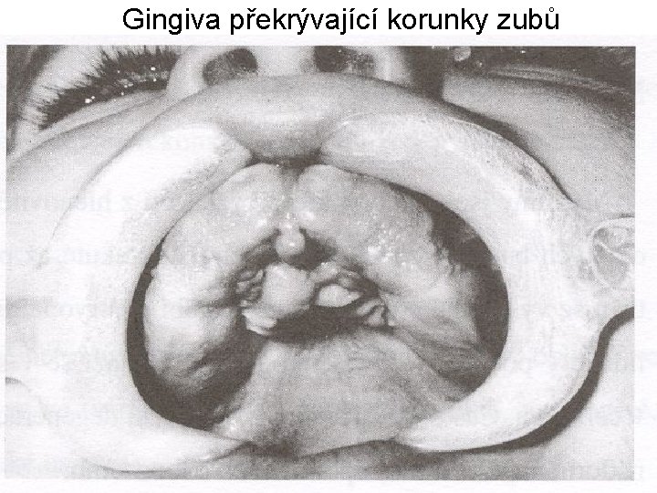 Gingiva překrývající korunky zubů 