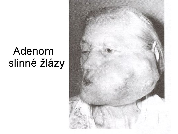 Adenom slinné žlázy 