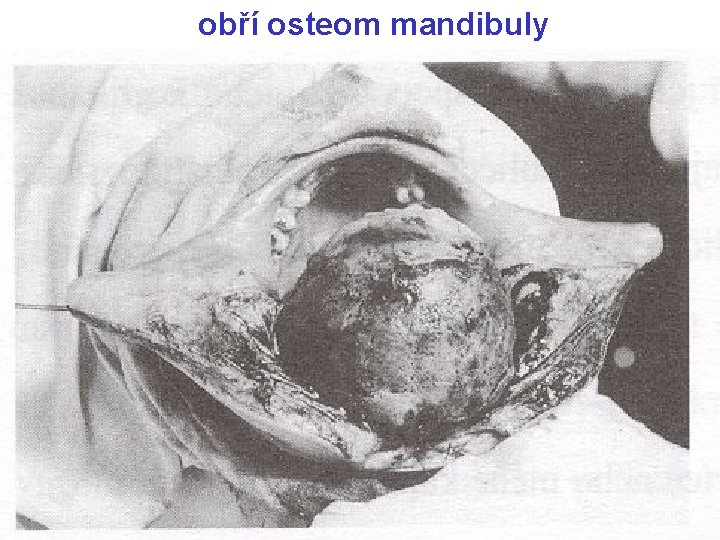 obří osteom mandibuly 