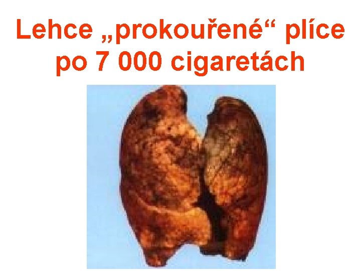 Lehce „prokouřené“ plíce po 7 000 cigaretách 