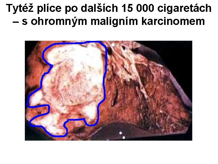Tytéž plíce po dalších 15 000 cigaretách – s ohromným maligním karcinomem 