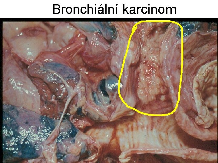 Bronchiální karcinom 
