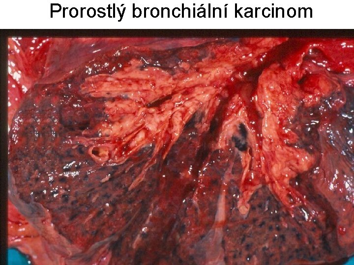 Prorostlý bronchiální karcinom 