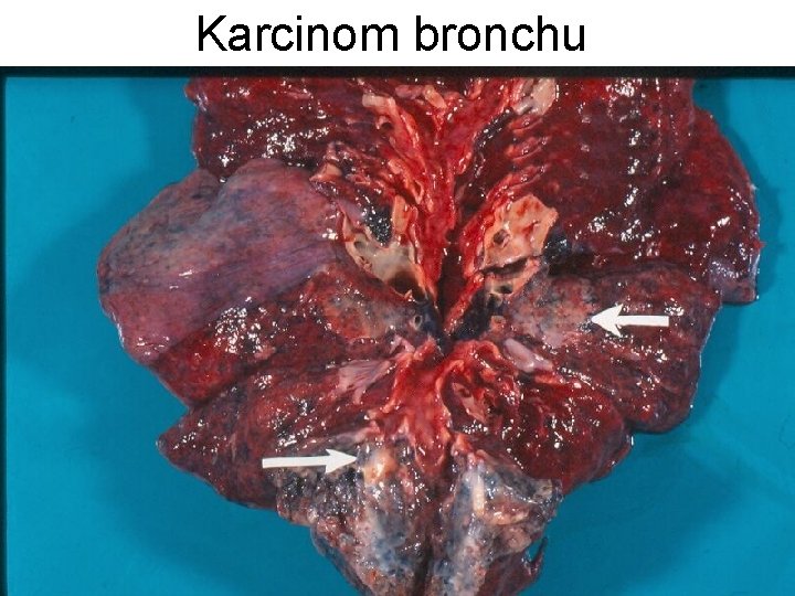 Karcinom bronchu 
