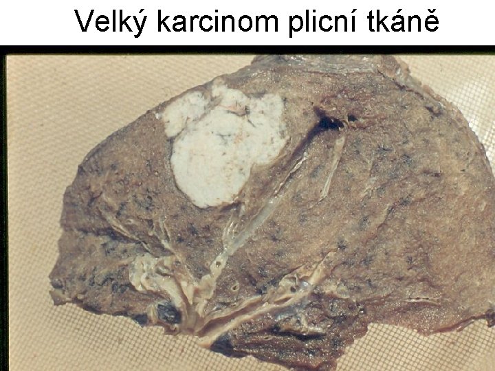 Velký karcinom plicní tkáně 