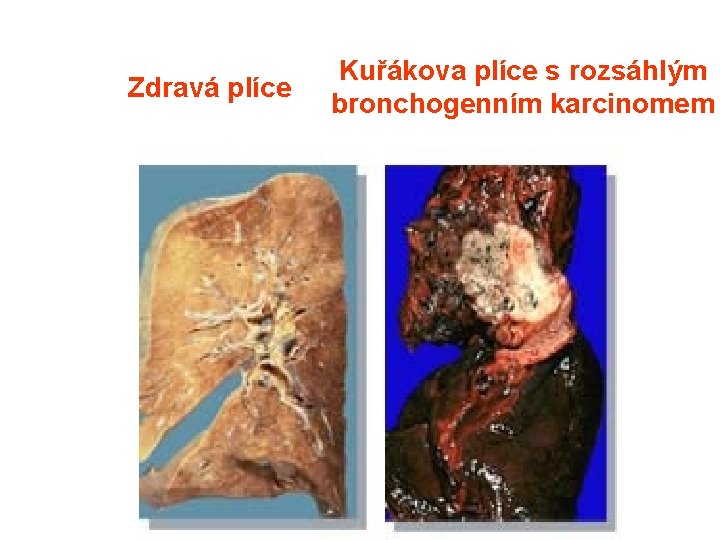 Zdravá plíce Kuřákova plíce s rozsáhlým bronchogenním karcinomem 