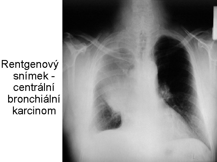Rentgenový snímek centrální bronchiální karcinom 