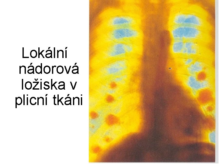 Lokální nádorová ložiska v plicní tkáni 