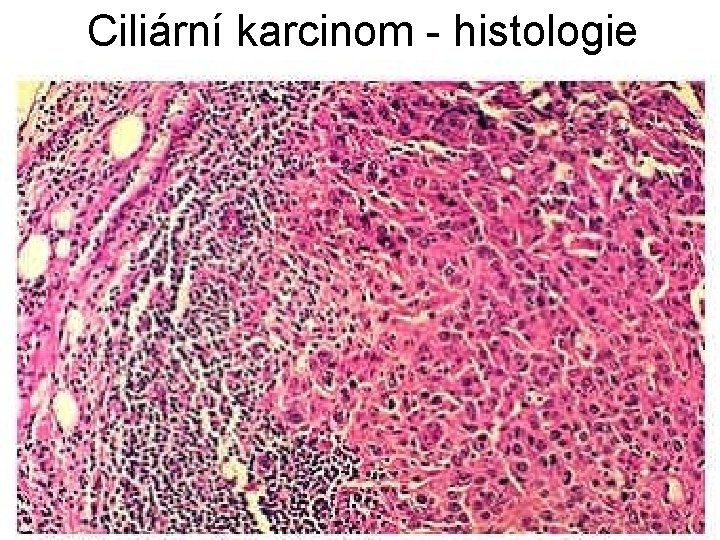 Ciliární karcinom - histologie 