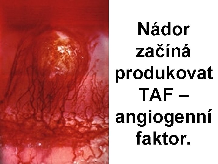 Nádor začíná produkovat TAF – angiogenní faktor. 