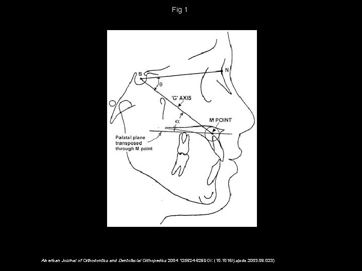 Fig 1 American Journal of Orthodontics and Dentofacial Orthopedics 2004 125624 -629 DOI: (10.