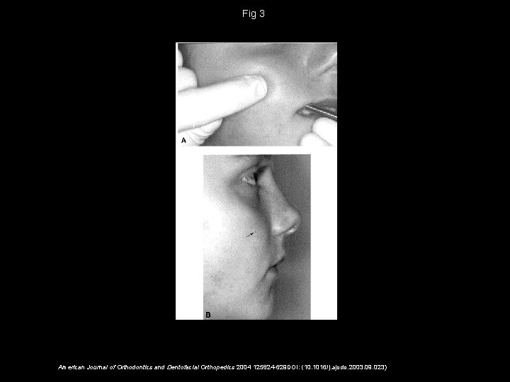 Fig 3 American Journal of Orthodontics and Dentofacial Orthopedics 2004 125624 -629 DOI: (10.