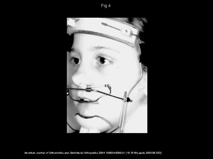 Fig 4 American Journal of Orthodontics and Dentofacial Orthopedics 2004 125624 -629 DOI: (10.