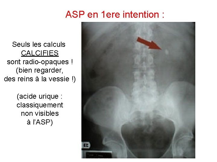 ASP en 1 ere intention : Seuls les calculs CALCIFIES sont radio-opaques ! (bien ASP en 1 ere intention : Seuls les calculs CALCIFIES sont radio-opaques ! (bien
