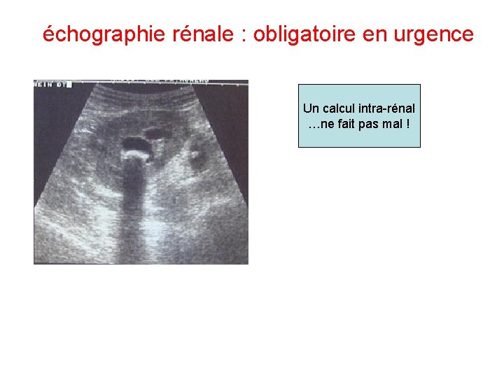 échographie rénale : obligatoire en urgence Un calcul intra-rénal …ne fait pas mal ! échographie rénale : obligatoire en urgence Un calcul intra-rénal …ne fait pas mal !