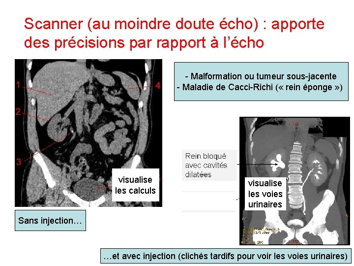 Scanner (au moindre doute écho) : apporte des précisions par rapport à l’écho - Scanner (au moindre doute écho) : apporte des précisions par rapport à l’écho -