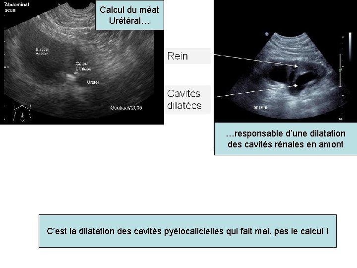 Calcul du méat Urétéral… …responsable d’une dilatation des cavités rénales en amont C’est la Calcul du méat Urétéral… …responsable d’une dilatation des cavités rénales en amont C’est la