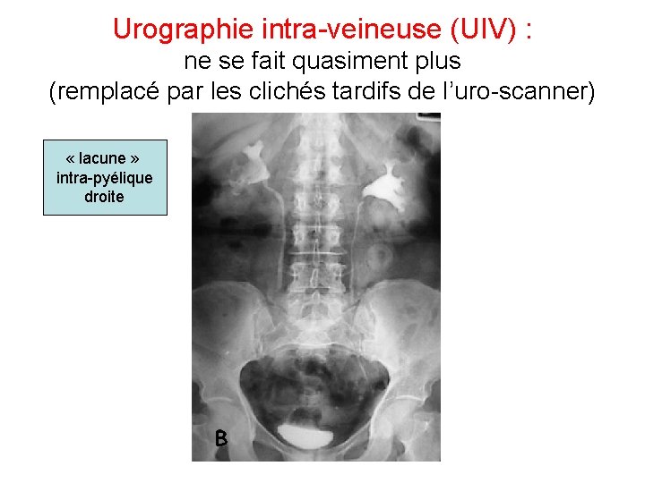 Urographie intra-veineuse (UIV) : ne se fait quasiment plus (remplacé par les clichés tardifs Urographie intra-veineuse (UIV) : ne se fait quasiment plus (remplacé par les clichés tardifs