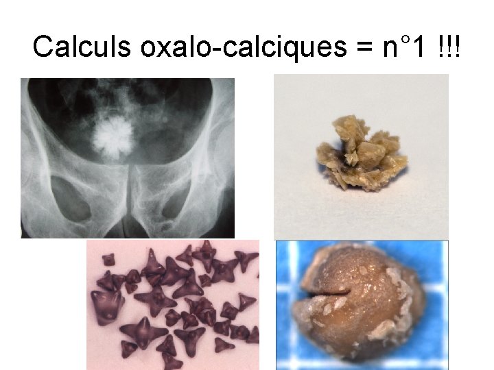 Calculs oxalo-calciques = n° 1 !!! Calculs oxalo-calciques = n° 1 !!!