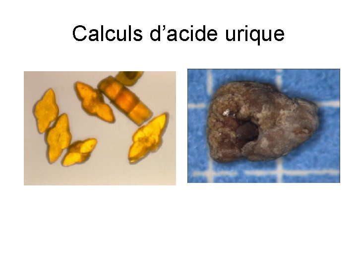 Calculs d’acide urique Calculs d’acide urique