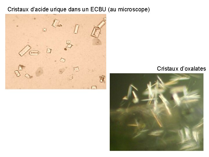 Cristaux d’acide urique dans un ECBU (au microscope) Cristaux d’oxalates Cristaux d’acide urique dans un ECBU (au microscope) Cristaux d’oxalates