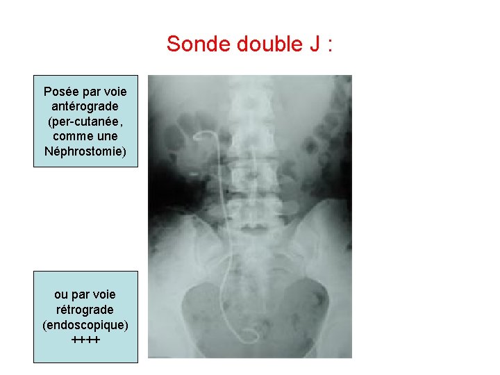 Sonde double J : Posée par voie antérograde (per-cutanée, comme une Néphrostomie) ou par Sonde double J : Posée par voie antérograde (per-cutanée, comme une Néphrostomie) ou par