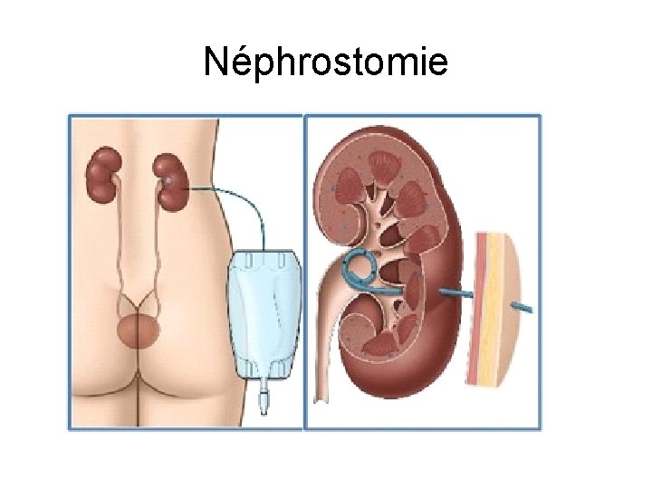 Néphrostomie Néphrostomie