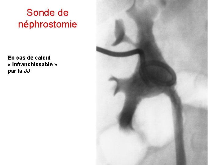 Sonde de néphrostomie En cas de calcul « infranchissable » par la JJ Sonde de néphrostomie En cas de calcul « infranchissable » par la JJ