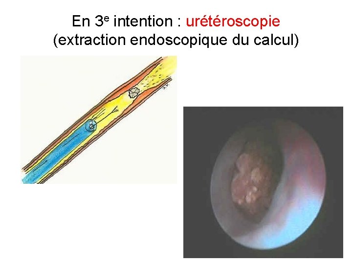 En 3 e intention : urétéroscopie (extraction endoscopique du calcul) En 3 e intention : urétéroscopie (extraction endoscopique du calcul)