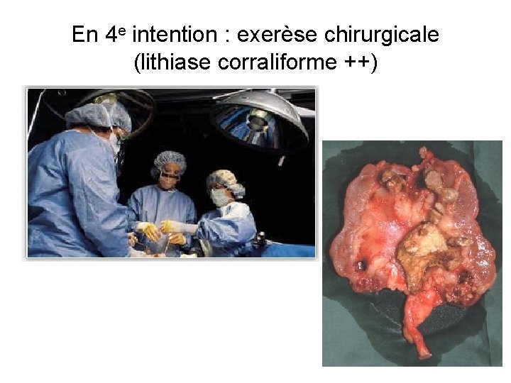 En 4 e intention : exerèse chirurgicale (lithiase corraliforme ++) En 4 e intention : exerèse chirurgicale (lithiase corraliforme ++)