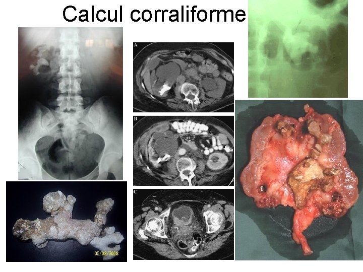 Calcul corraliforme Calcul corraliforme