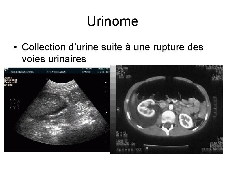Urinome • Collection d’urine suite à une rupture des voies urinaires Urinome • Collection d’urine suite à une rupture des voies urinaires