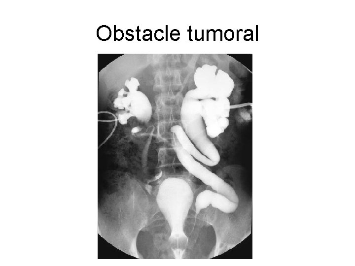 Obstacle tumoral Obstacle tumoral