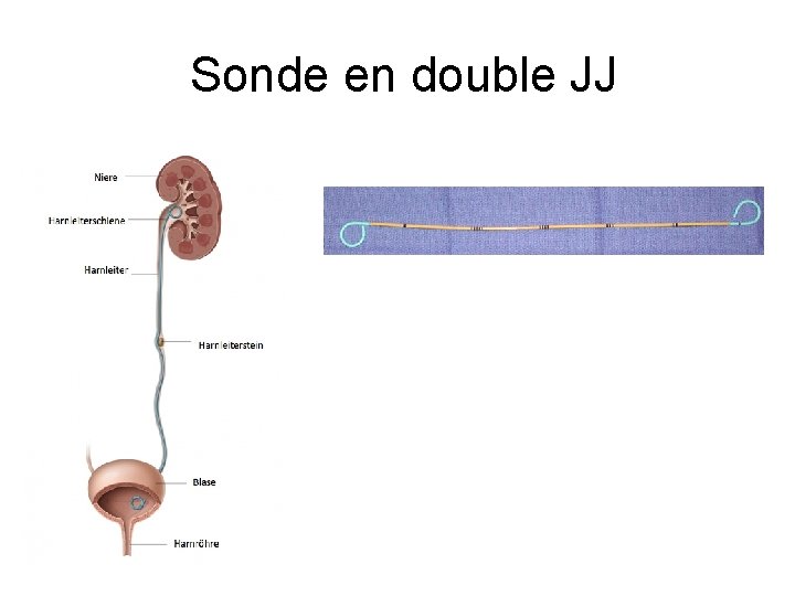 Sonde en double JJ Sonde en double JJ