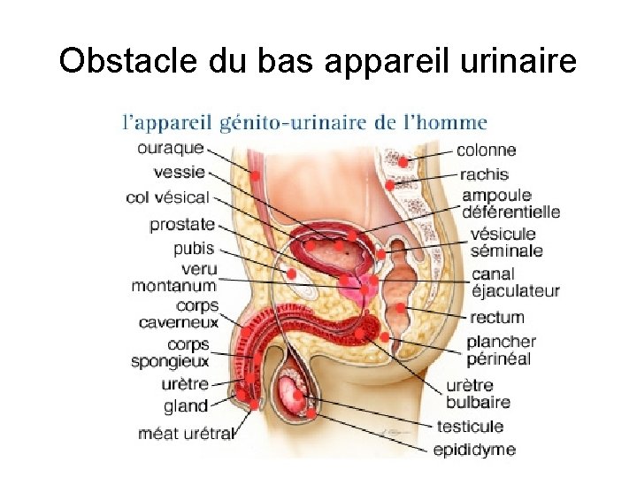 Obstacle du bas appareil urinaire Obstacle du bas appareil urinaire