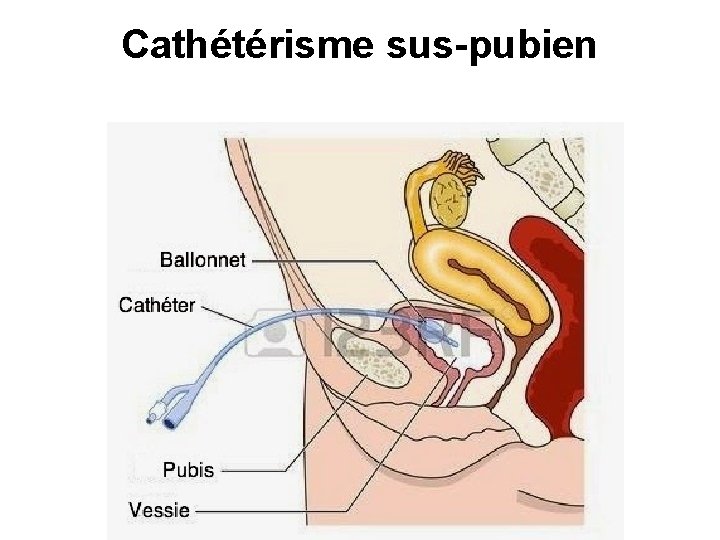 Cathétérisme sus-pubien Cathétérisme sus-pubien