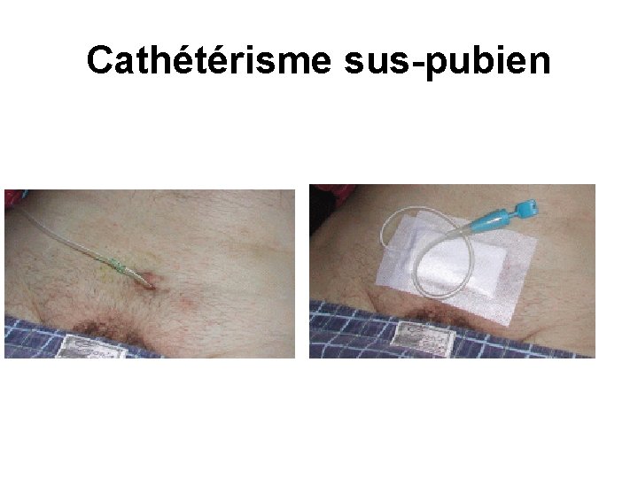 Cathétérisme sus-pubien Cathétérisme sus-pubien