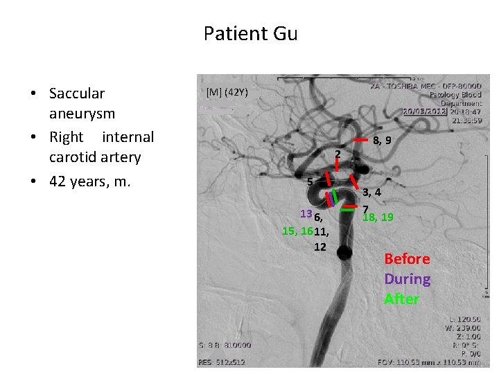 Patient Gu • Saccular aneurysm • Right internal carotid artery • 42 years, m.