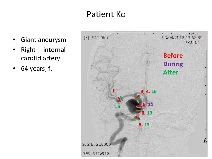Patient Ko • Giant aneurysm • Right internal carotid artery • 64 years, f.