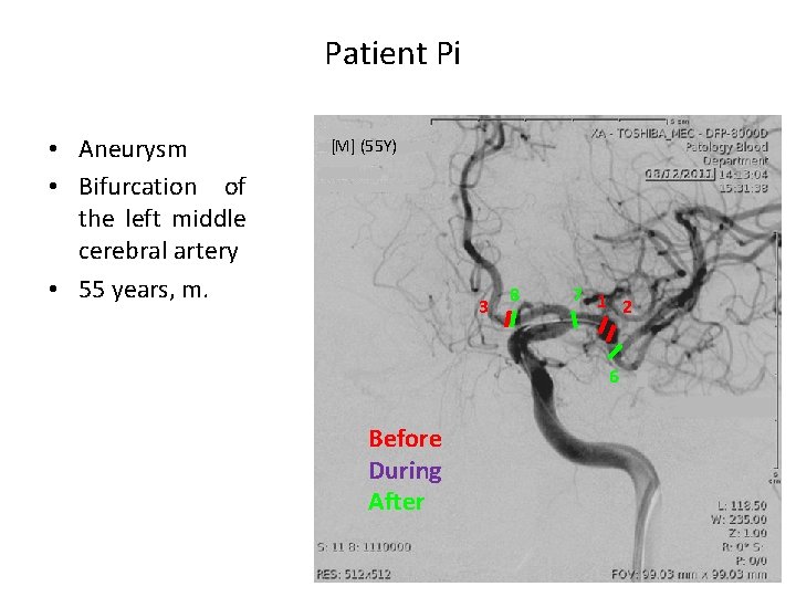 Patient Pi • Aneurysm • Bifurcation of the left middle cerebral artery • 55