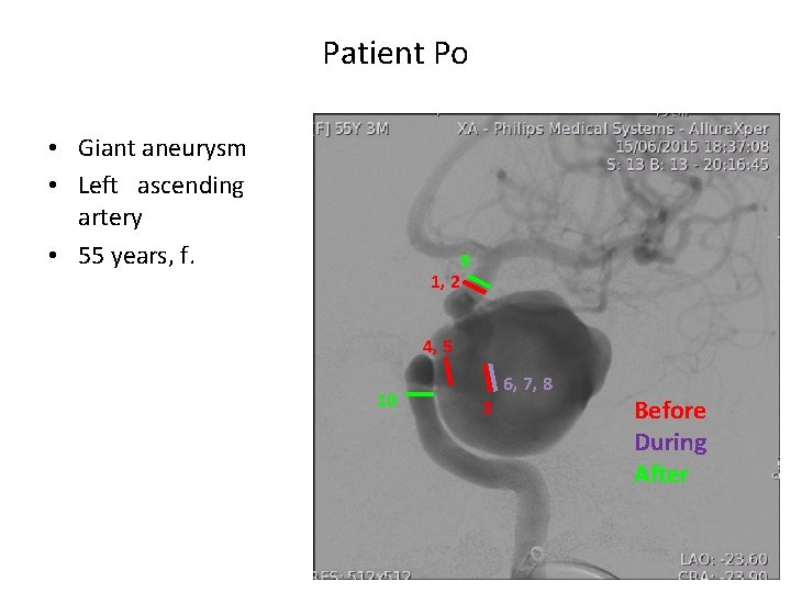 Patient Po • Giant aneurysm • Left ascending artery • 55 years, f. 1,