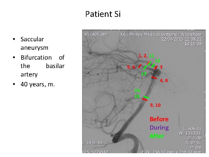Patient Si • Saccular aneurysm • Bifurcation of the basilar artery • 40 years,