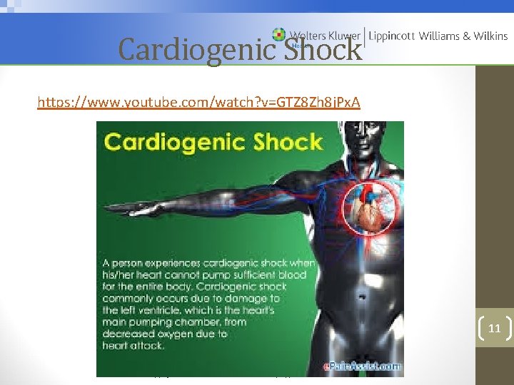 Cardiogenic Shock https: //www. youtube. com/watch? v=GTZ 8 Zh 8 j. Px. A 11