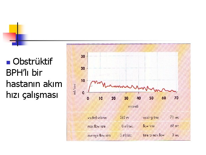 Obstrüktif BPH’lı bir hastanın akım hızı çalışması n 