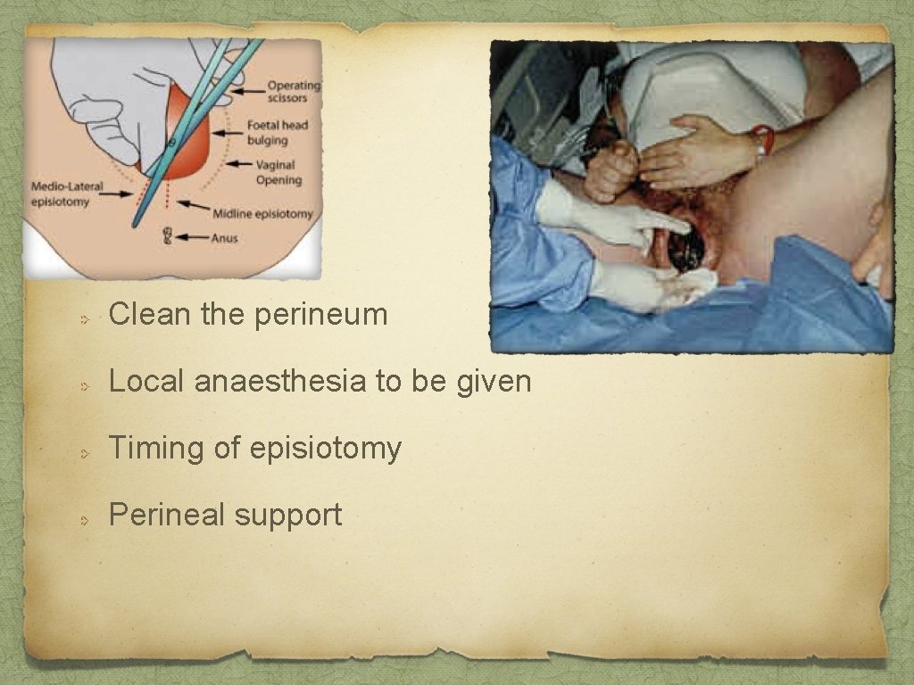 Clean the perineum Local anaesthesia to be given Timing of episiotomy Perineal support 